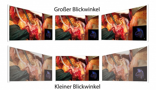 Monitor - Endo 4K - Blickwinkel EX5841