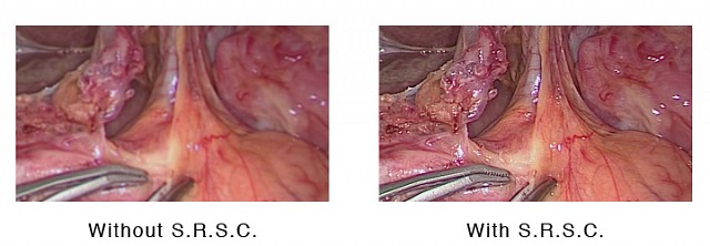 Monitor - Endo - S.R.S.C - EX2621